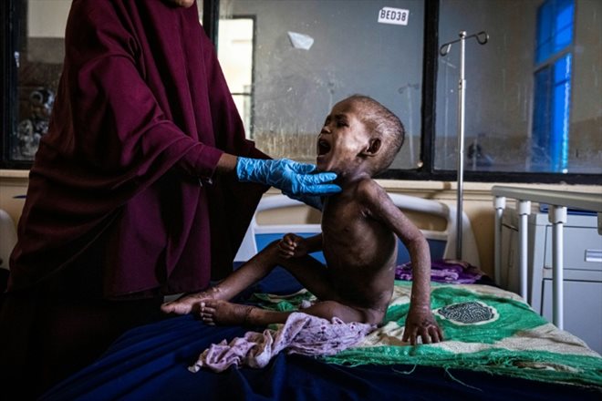 Ali Abdullahi Mohamed, 27 mois, souffrant de malnutrition sévère, est examiné par une infirmière dans un hôpital de Mogadiscio, en Somalie en proie à la sécheresse, le 1er juin 2022